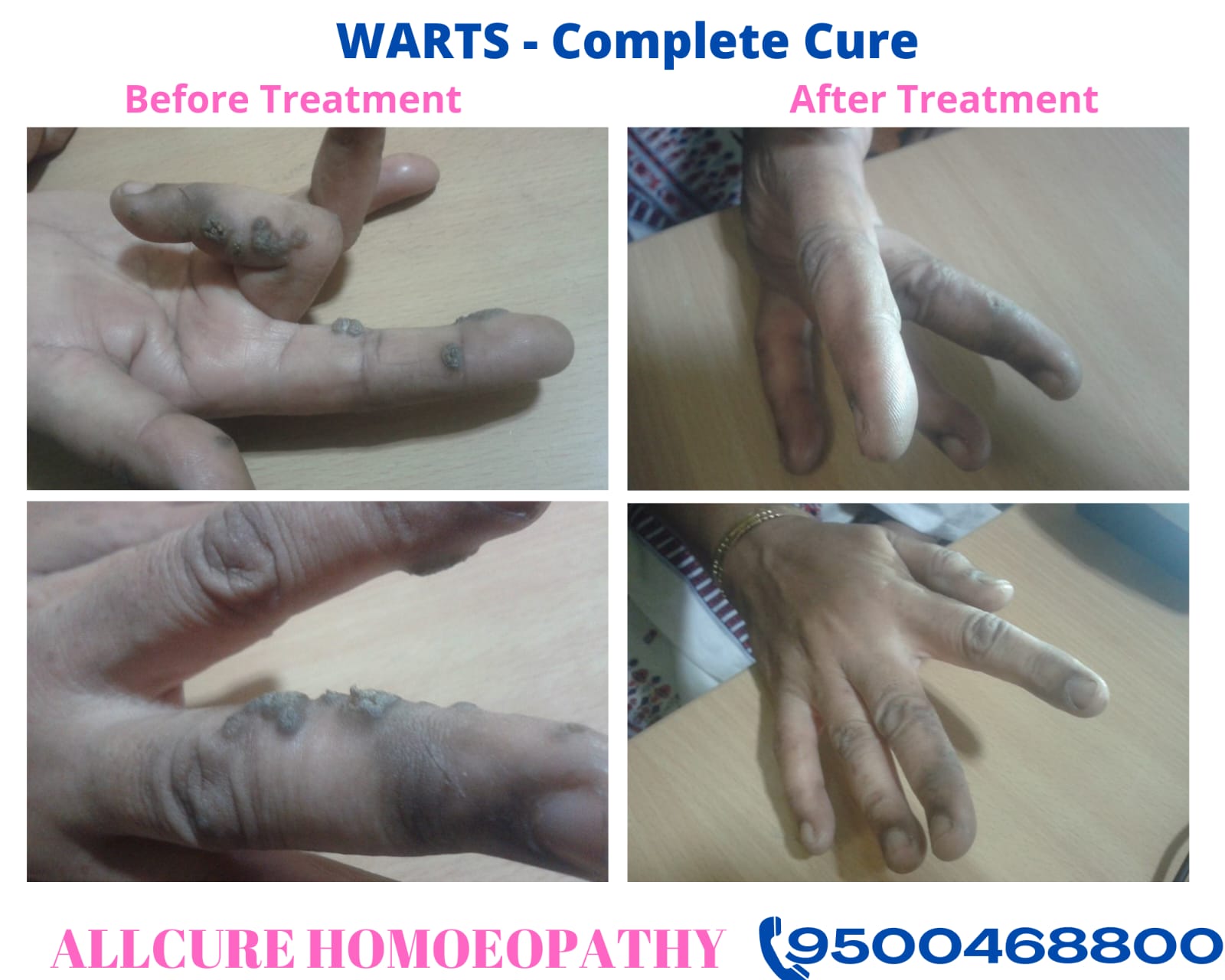 Warts on a patient's fingers and hand before treatment, and the same hand after homoeopathic treatment at Allcure Homoeopathy