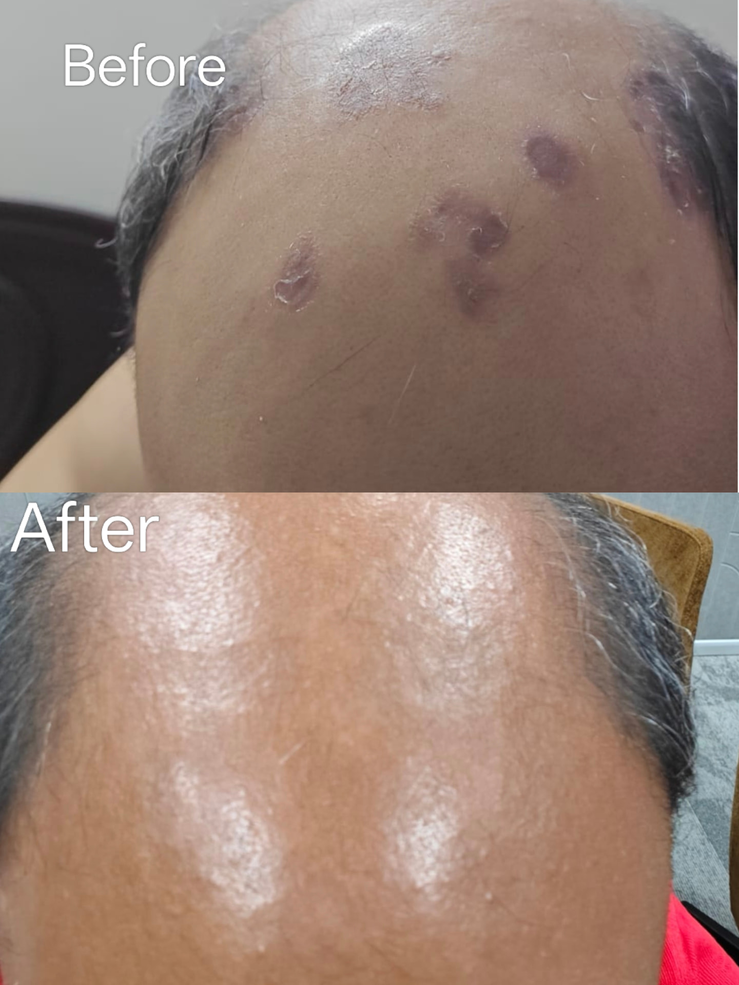 Lesions on a patient's scalp before treatment shown above the same scalp after homoeopathic treatment
