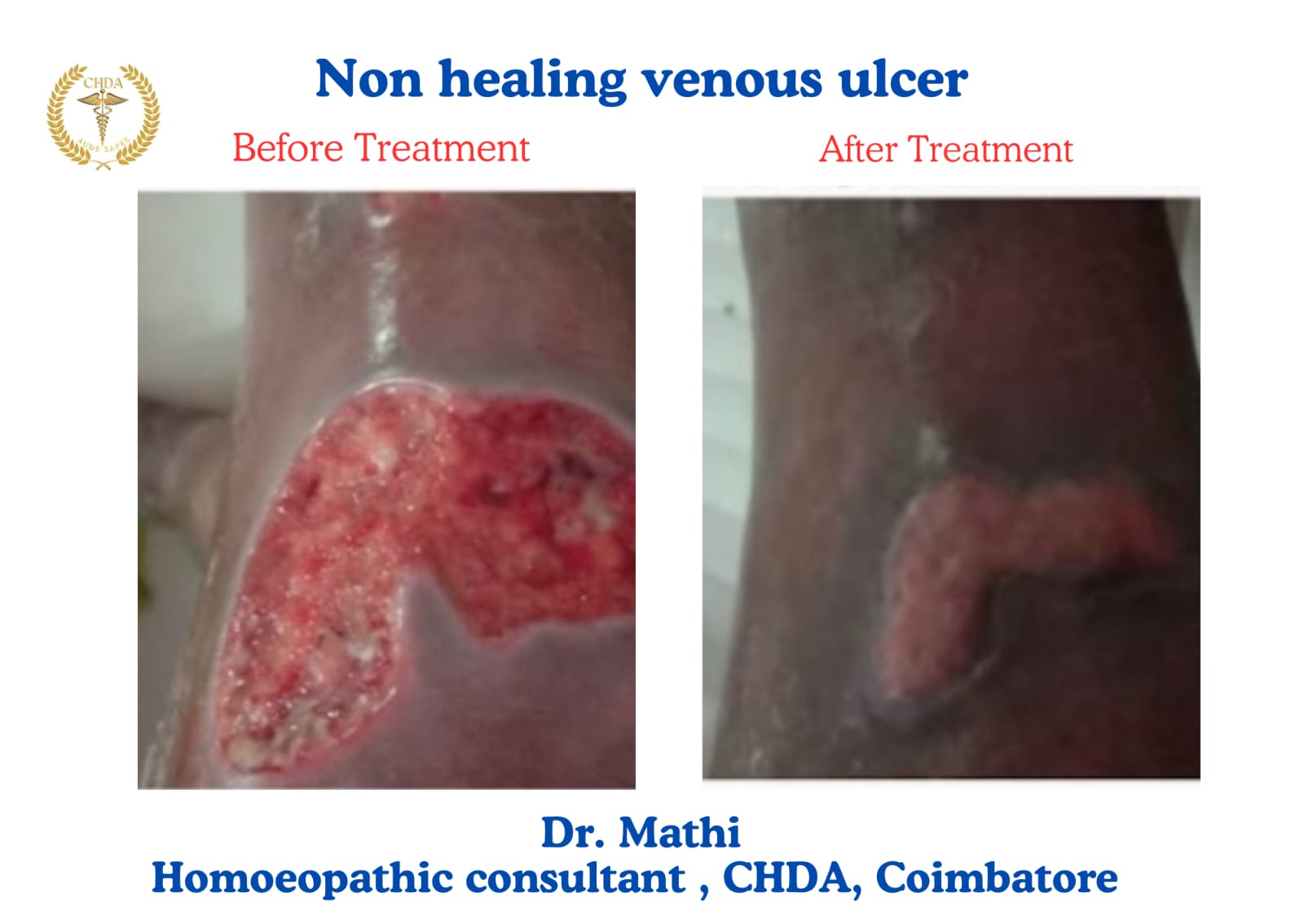 A non-healing venous ulcer on a patient's leg before treatment compared with the healing wound after homoeopathic treatment