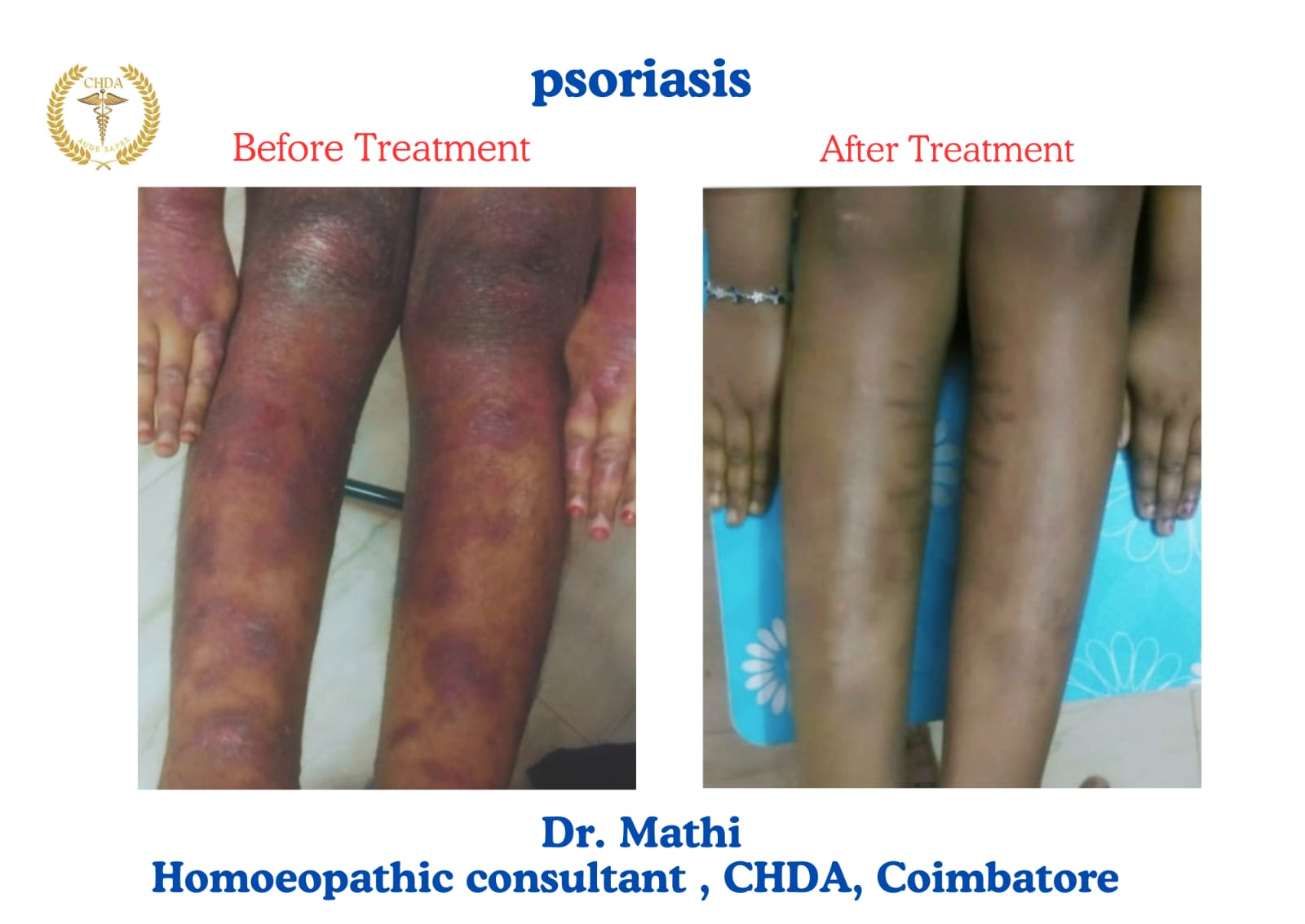 Psoriasis on a patient's legs before treatment compared with the same legs after homoeopathic treatment